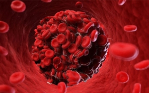 P&uacute;rpura Trombocitop&eacute;nica Tromb&oacute;tica, enfermedad hu&eacute;rfana de alta mortalidad
