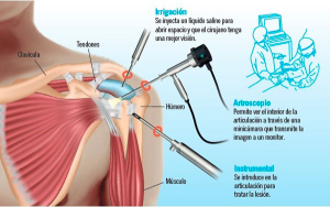 Reemplazo de hombro ambulatorio: Recuperaci&oacute;n sin hospitalizaci&oacute;n
