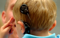 Implante coclear, la opci&oacute;n para que muchos recuperen la audici&oacute;n